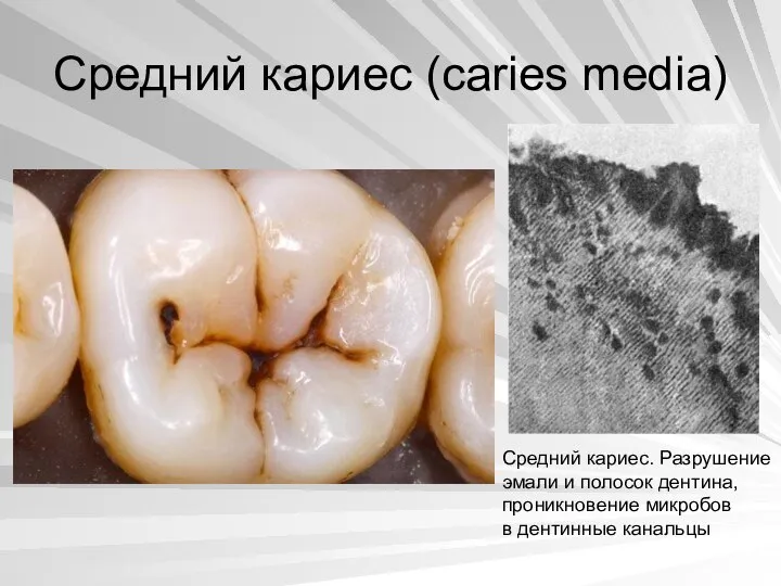 Средний кариес (caries media) Средний кариес. Разрушение эмали и полосок дентина, проникновение микробов в дентинные канальцы