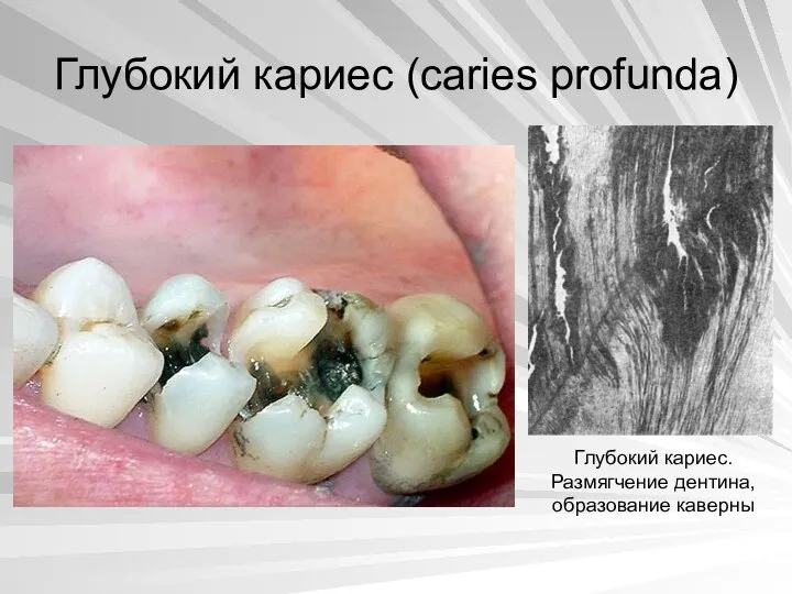 Глубокий кариес (caries profunda) Глубокий кариес. Размягчение дентина, образование каверны