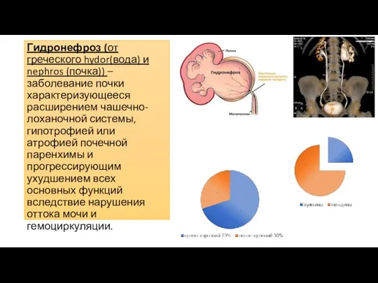 Гидронефроз (от греческого hydor(вода) и nephros (почка)) – заболевание почки характеризующееся расширением