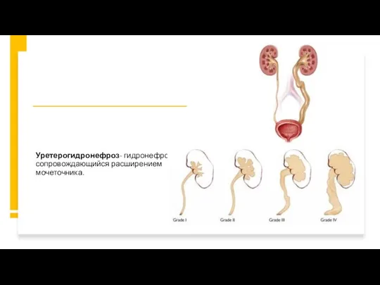 Уретерогидронефроз- гидронефроз сопровождающийся расширением мочеточника.