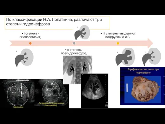 По классификации Н.А. Лопаткина, различают три степени гидронефроза