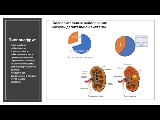 Пиелонефрит Пиелонефрит - инфекционно-воспалительное заболевание почек с преимущественным поражением чашечно-лоханочной системы, тубулоинтерстициальной