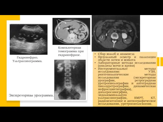 Гидронефроз. Ультрасонограмма. Экскреторная урограмма. Компьютерная томограмма при гидронефрозе. Сбор жалоб и анамнеза