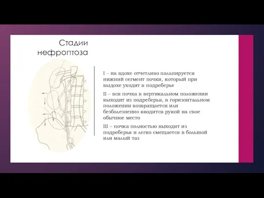 Стадии нефроптоза I – на вдохе отчетливо пальпируется нижний сегмент почки, который