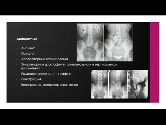 Анамнез Осмотр Лабораторные исследования Экскреторная урография в горизонтальном и вертикальном положениях Радиоизотопная