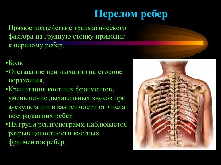 Прямое воздействие травматического фактора на грудную стенку приводит к перелому ребер. Боль