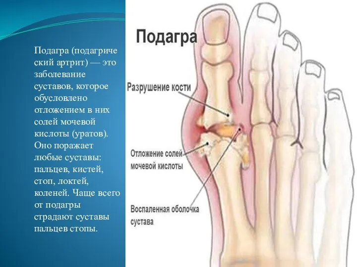 Подагра (подагрический артрит) — это заболевание суставов, которое обусловлено отложением в них