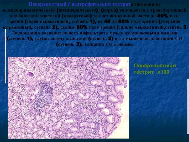 Поверхностный гастрит, х100. Поверхностный / неатрофический гастрит: эпителий из высокопризматического (цилиндрического) (норма)