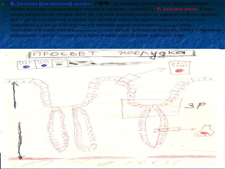 5. Дисплазия (или неоплазия) желудка - в 1978 году дисплазия эпителия в