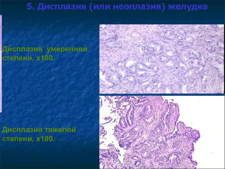 5. Дисплазия (или неоплазия) желудка Дисплазия умеренной степени, х100. Дисплазия тяжелой степени, х100.
