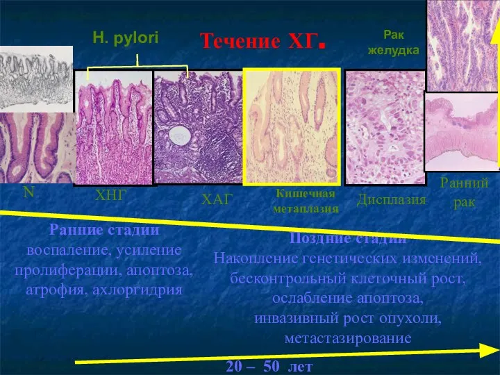 Ранние стадии воспаление, усиление пролиферации, апоптоза, атрофия, ахлоргидрия Рак желудка Дисплазия ХАГ