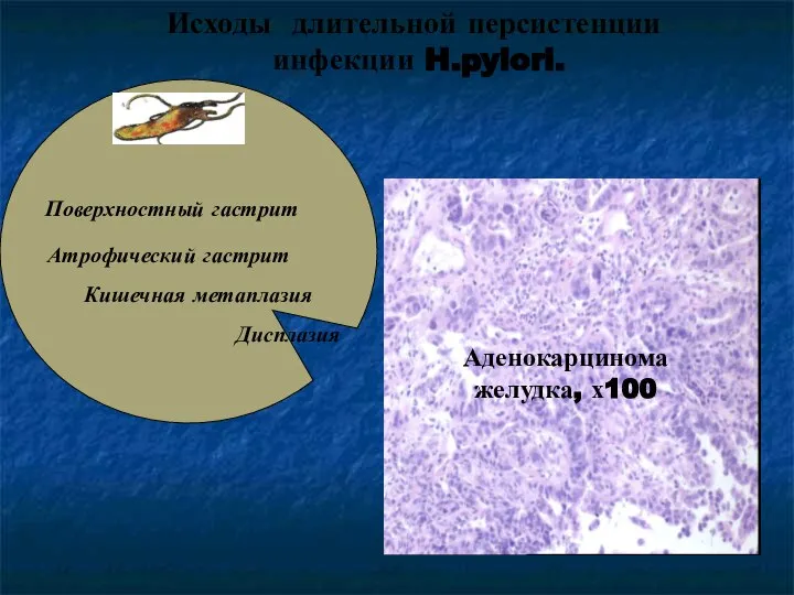 Исходы длительной персистенции инфекции H.pylori. Аденокарцинома желудка, х100 Поверхностный гастрит Атрофический гастрит Кишечная метаплазия Дисплазия