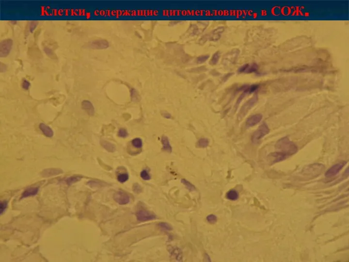 Клетки, содержащие цитомегаловирус, в СОЖ.