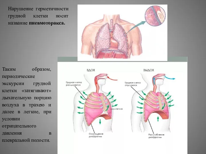 Нарушение герметичности грудной клетки носит название пневмоторакса. Таким образом, периодические экскурсии грудной