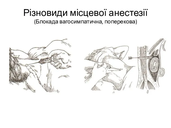 Різновиди місцевої анестезії (Блокада вагосимпатична, поперекова)