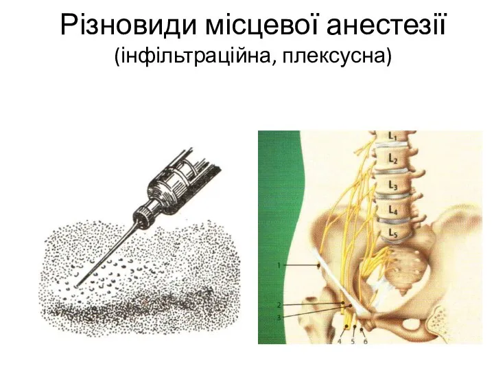 Різновиди місцевої анестезії (інфільтраційна, плексусна)