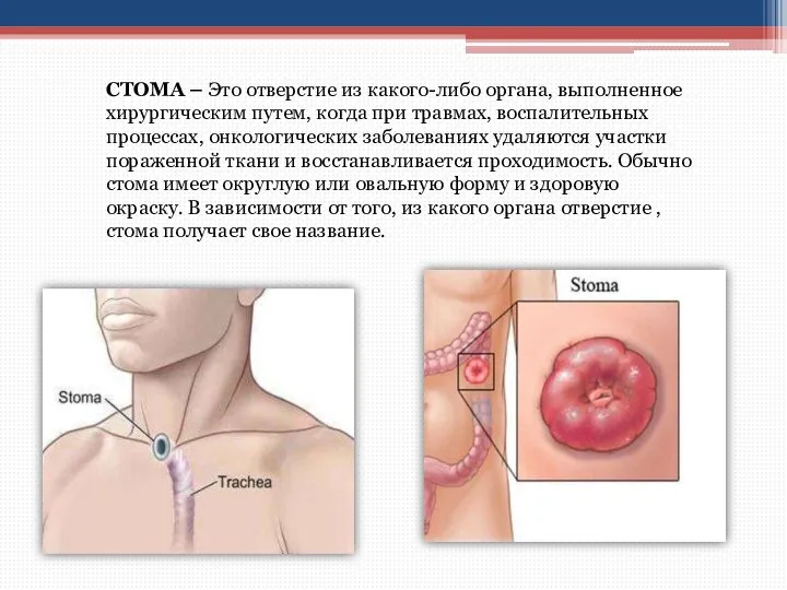 СТОМА – Это отверстие из какого-либо органа, выполненное хирургическим путем, когда при