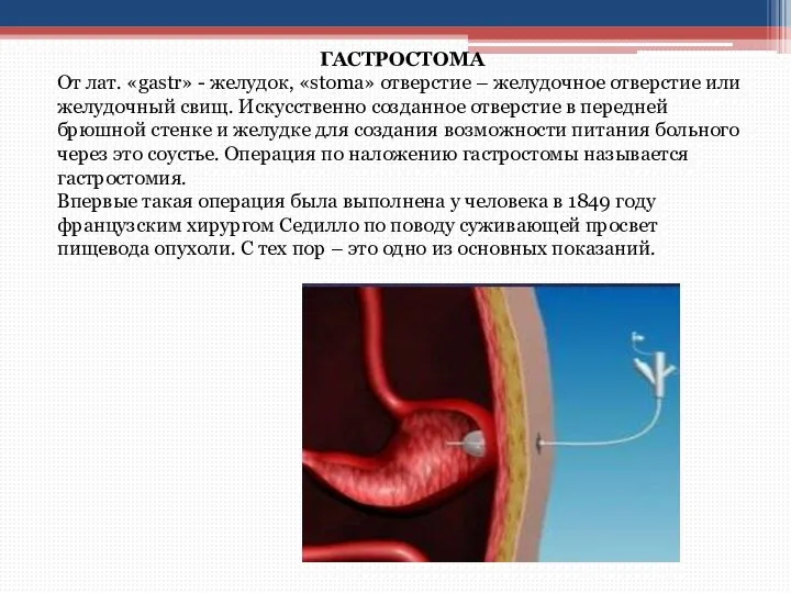 ГАСТРОСТОМА От лат. «gastr» - желудок, «stoma» отверстие – желудочное отверстие или