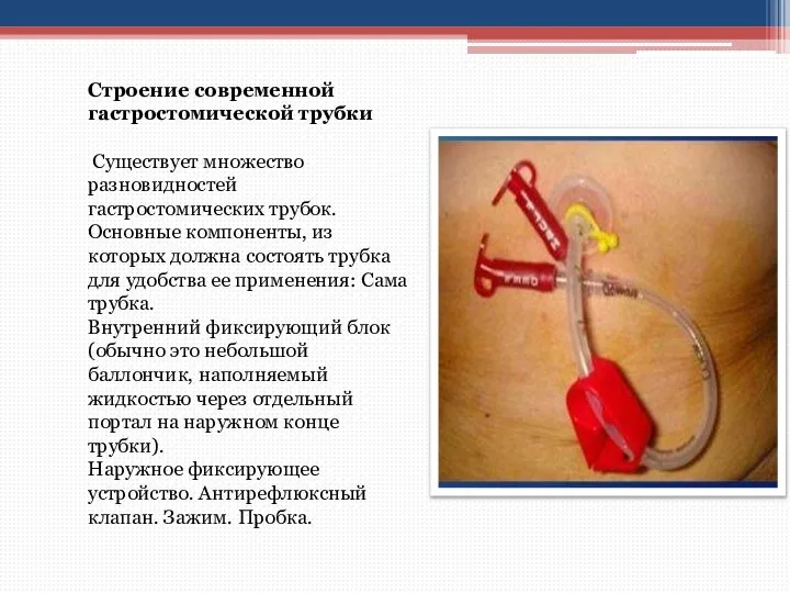 Строение современной гастростомической трубки Существует множество разновидностей гастростомических трубок. Основные компоненты, из