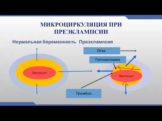 МИКРОЦИРКУЛЯЦИЯ ПРИ ПРЕЭКЛАМПСИИ Нормальная беременность Преэклампсия Эритроцит Эритроцит Отек Гиповолемия Тромбоз