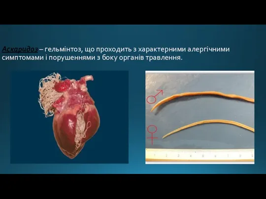 Аскаридоз – гельмінтоз, що проходить з характерними алергічними симптомами і порушеннями з боку органів травлення.