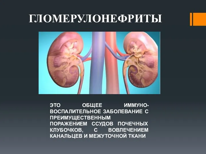 ГЛОМЕРУЛОНЕФРИТЫ ЭТО ОБЩЕЕ ИММУНО-ВОСПАЛИТЕЛЬНОЕ ЗАБОЛЕВАНИЕ С ПРЕИМУЩЕСТВЕННЫМ ПОРАЖЕНИЕМ ССУДОВ ПОЧЕЧНЫХ КЛУБОЧКОВ, С