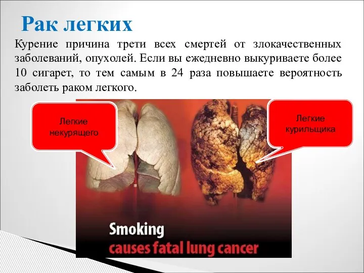 Рак легких Курение причина трети всех смертей от злокачественных заболеваний, опухолей. Если