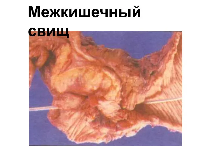 Межкишечный свищ