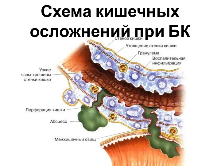 Схема кишечных осложнений при БК