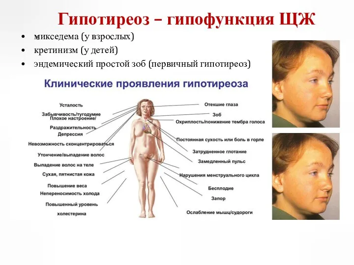 микседема (у взрослых) кретинизм (у детей) эндемический простой зоб (первичный гипотиреоз) Гипотиреоз – гипофункция ЩЖ