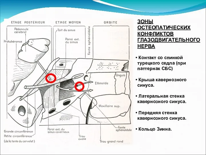 ЗОНЫ ОСТЕОПАТИЧЕСКИХ КОНФЛИКТОВ ГЛАЗОДВИГАТЕЛЬНОГО НЕРВА Контакт со спинкой турецкого седла (при паттернах