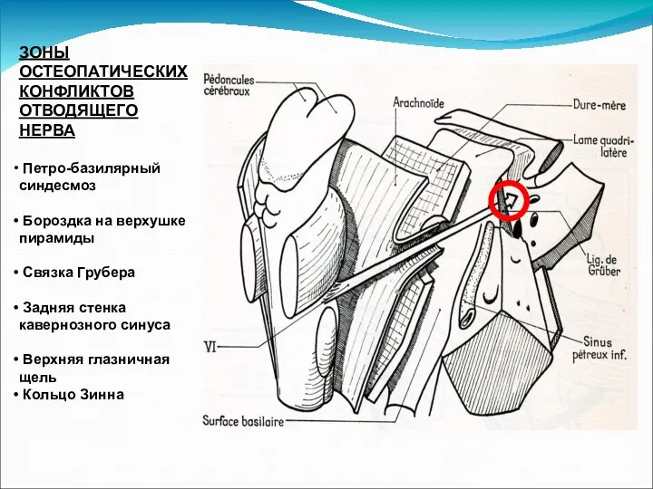 ЗОНЫ ОСТЕОПАТИЧЕСКИХ КОНФЛИКТОВ ОТВОДЯЩЕГО НЕРВА Петро-базилярный синдесмоз Бороздка на верхушке пирамиды Связка