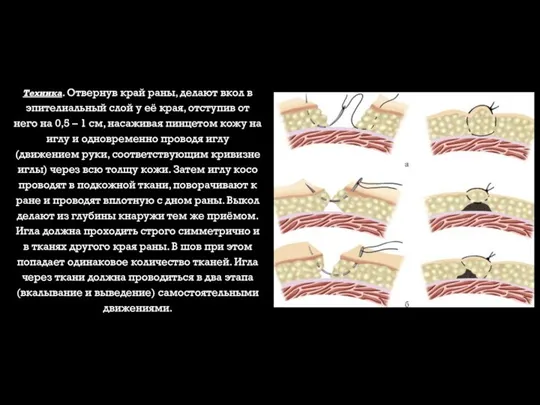 Техника. Отвернув край раны, делают вкол в эпителиальный слой у её края,