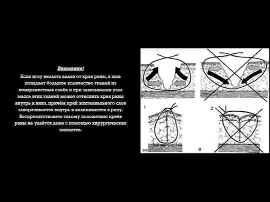 Внимание! Если иглу вколоть вдали от края раны, в шов попадает большое