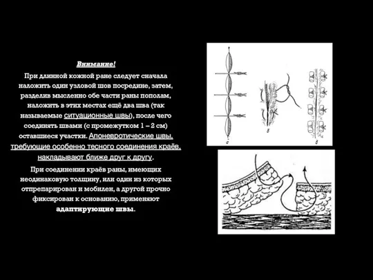 Внимание! При длинной кожной ране следует сначала наложить один узловой шов посредине,