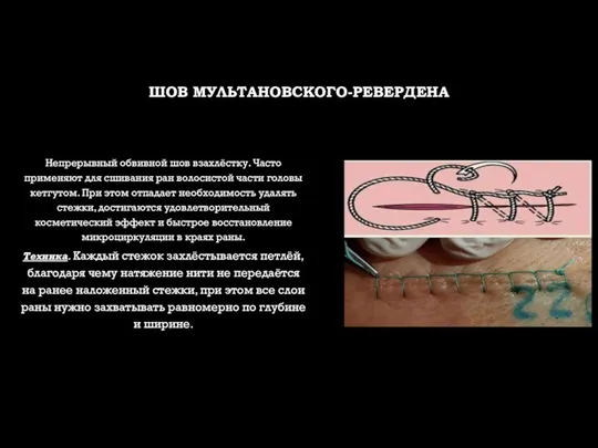 ШОВ МУЛЬТАНОВСКОГО-РЕВЕРДЕНА Непрерывный обвивной шов взахлёстку. Часто применяют для сшивания ран волосистой