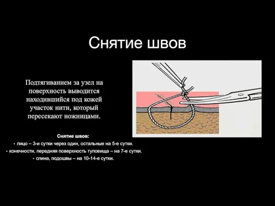 Снятие швов Подтягиванием за узел на поверхность выводится находившийся под кожей участок