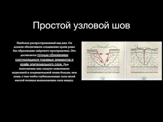 Простой узловой шов Наиболее распространенный вид шва. Он должен обеспечивать соединение краёв