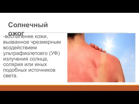 -воспаление кожи, вызванное чрезмерным воздействием ультрафиолетовго (УФ) излучения солнца, солярия или иных
