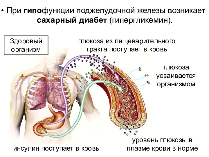 При гипофункции поджелудочной железы возникает сахарный диабет (гипергликемия). глюкоза из пищеварительного тракта