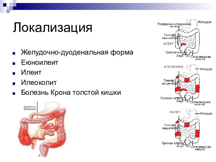 Локализация Желудочно-дуоденальная форма Еюноилеит Илеит Илеоколит Болезнь Крона толстой кишки