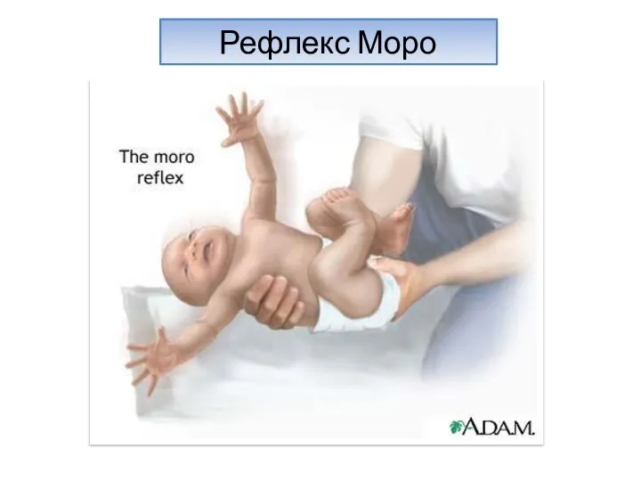 Рефлекс Моро