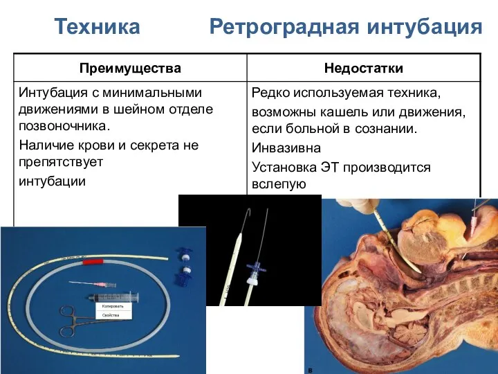 Техника Ретроградная интубация