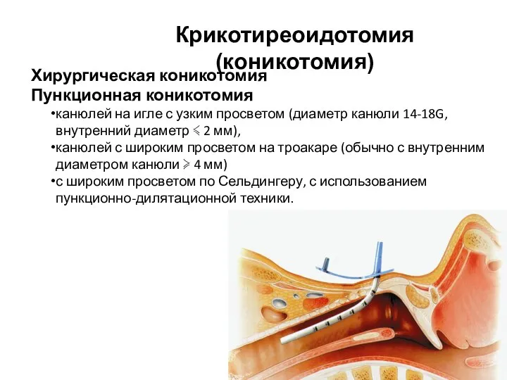 Хирургическая коникотомия Пункционная коникотомия канюлей на игле с узким просветом (диаметр канюли