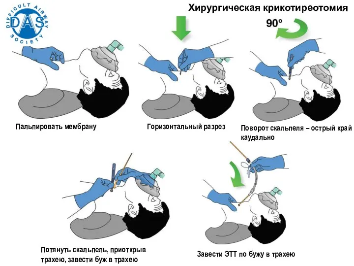 Хирургическая крикотиреотомия Пальпировать мембрану Горизонтальный разрез Поворот скальпеля – острый край каудально