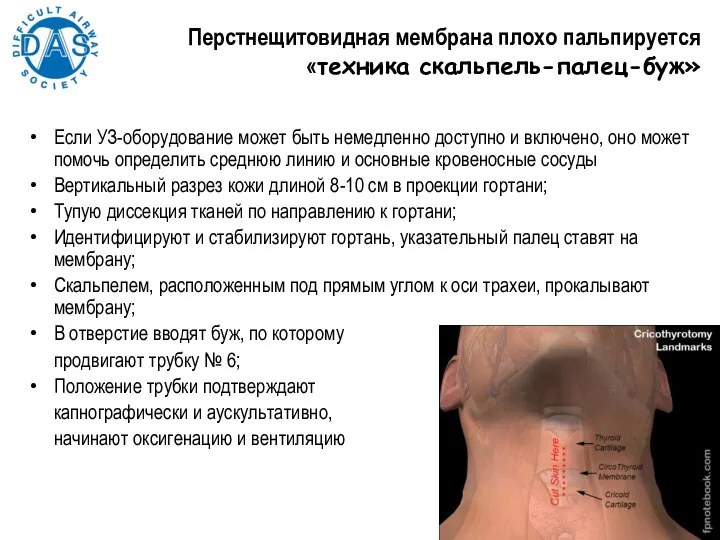 Перстнещитовидная мембрана плохо пальпируется «техника скальпель-палец-буж» Если УЗ-оборудование может быть немедленно доступно