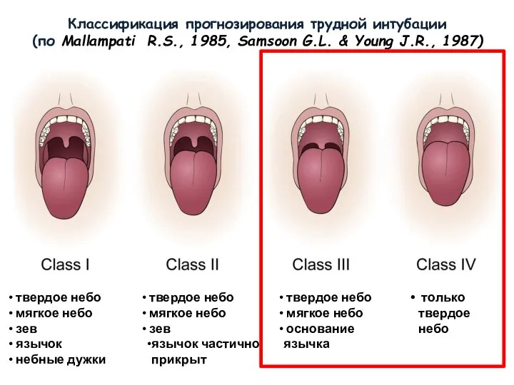 Классификация прогнозирования трудной интубации (по Mallampati R.S., 1985, Samsoon G.L. & Young J.R., 1987)