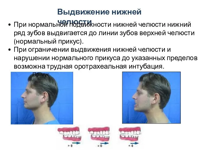 Прикус Выдвижение нижней челюсти При нормальной подвижности нижней челюсти нижний ряд зубов
