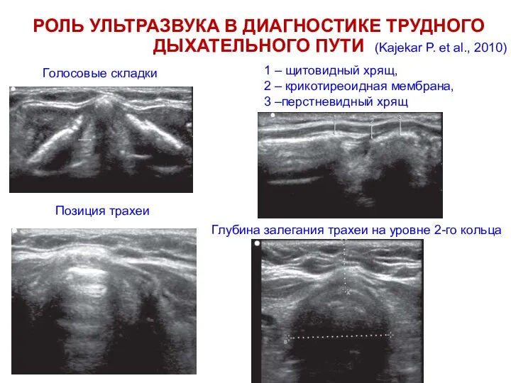 РОЛЬ УЛЬТРАЗВУКА В ДИАГНОСТИКЕ ТРУДНОГО ДЫХАТЕЛЬНОГО ПУТИ Позиция трахеи Голосовые складки 1