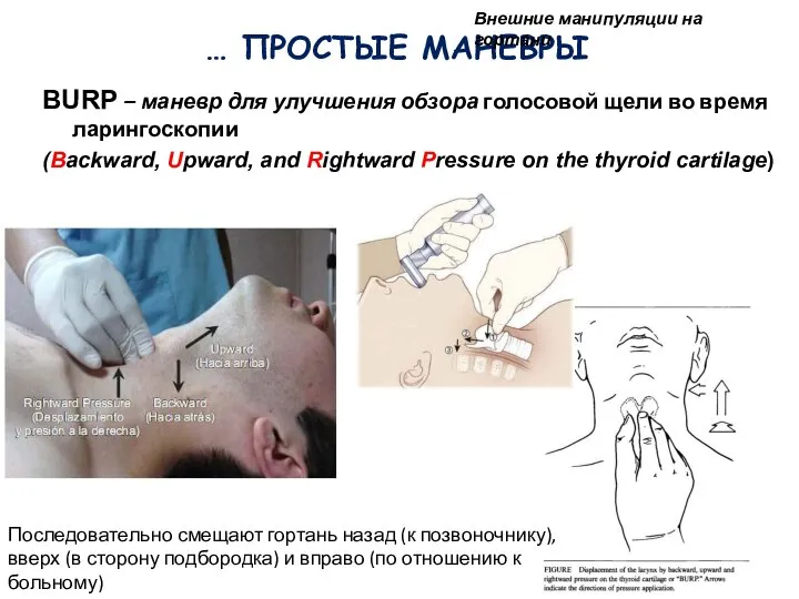 … ПРОСТЫЕ МАНЕВРЫ BURP – маневр для улучшения обзора голосовой щели во